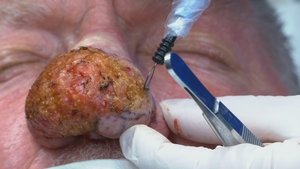 Lessons in Pimple Popping